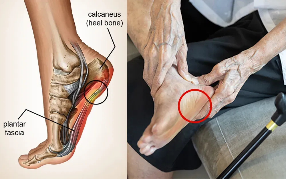 Plantar fasciitis heel pain diagram